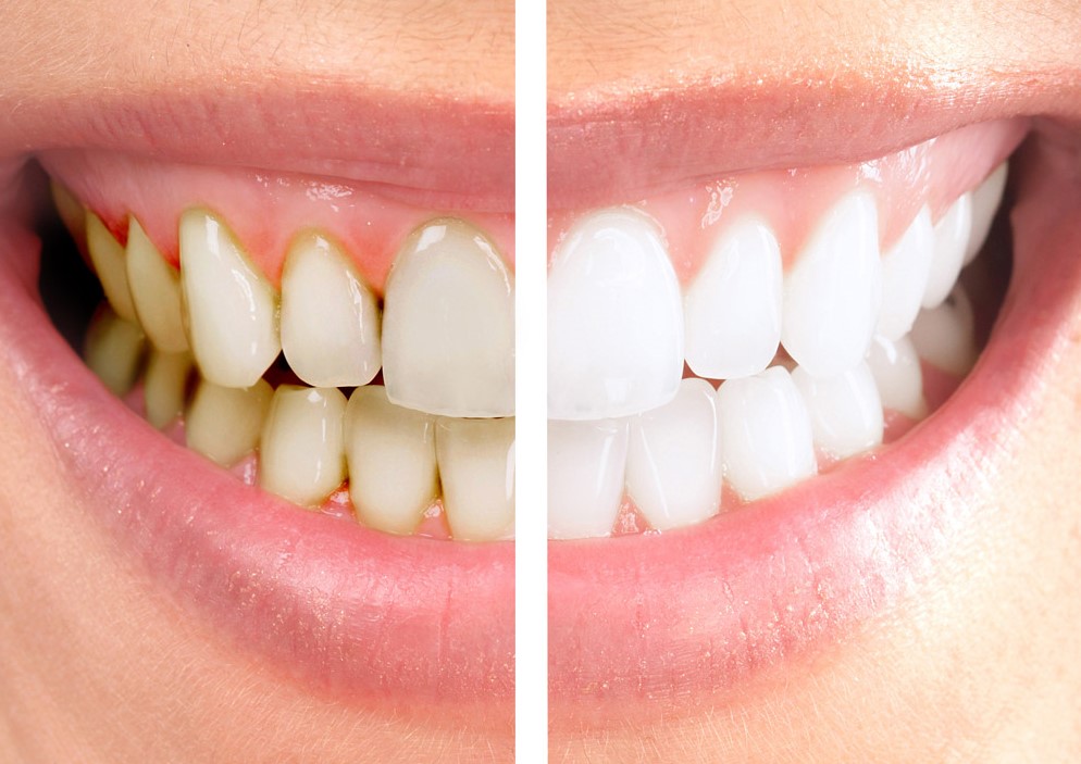 Professional Teeth Whitening vs. Whitening Strips