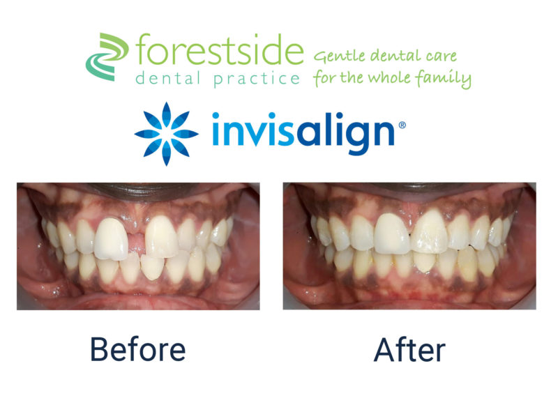 invisalign before and after new forest