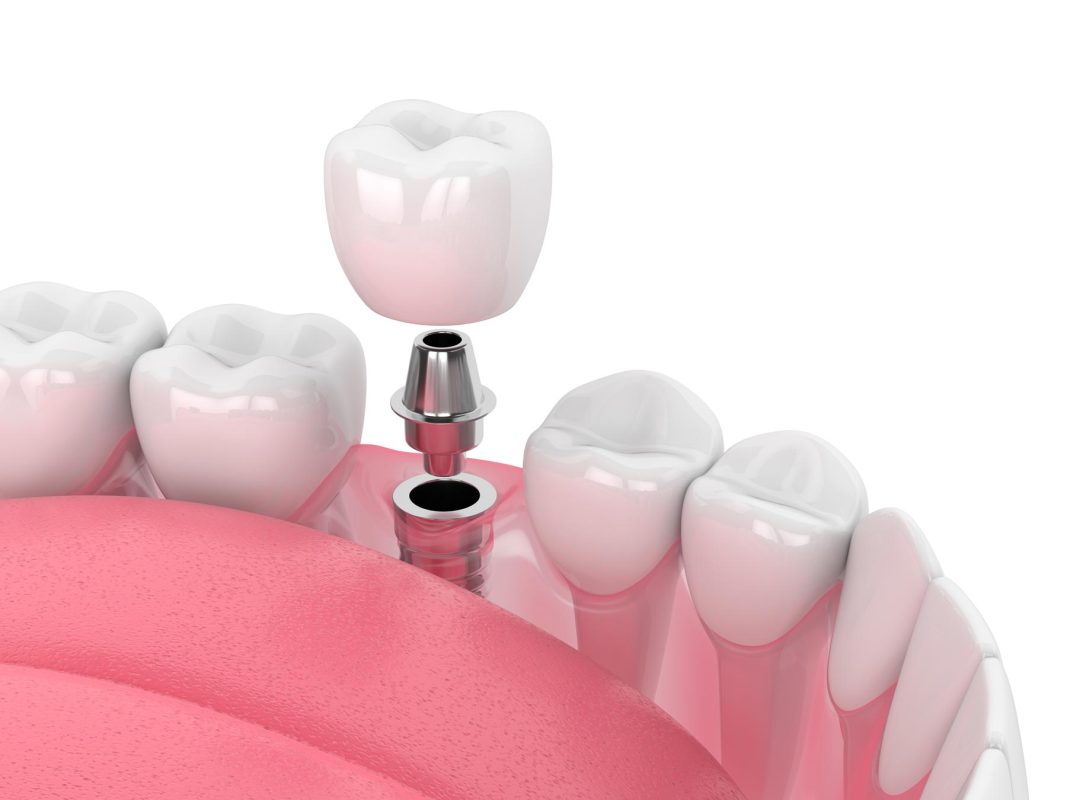 perfect-smile-dental-implants