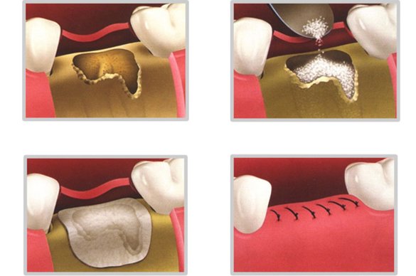 demooo bone graft new forest