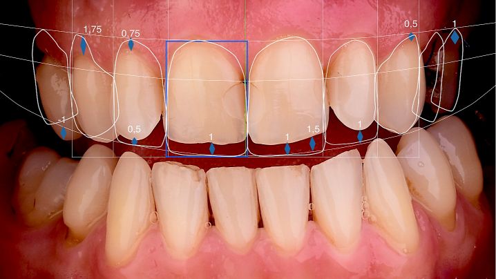 DSD smile makeover cosmetic dentistry New Forest crowns, veneers, bridges & dentures