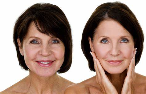 th face fillers before and after photos new forest