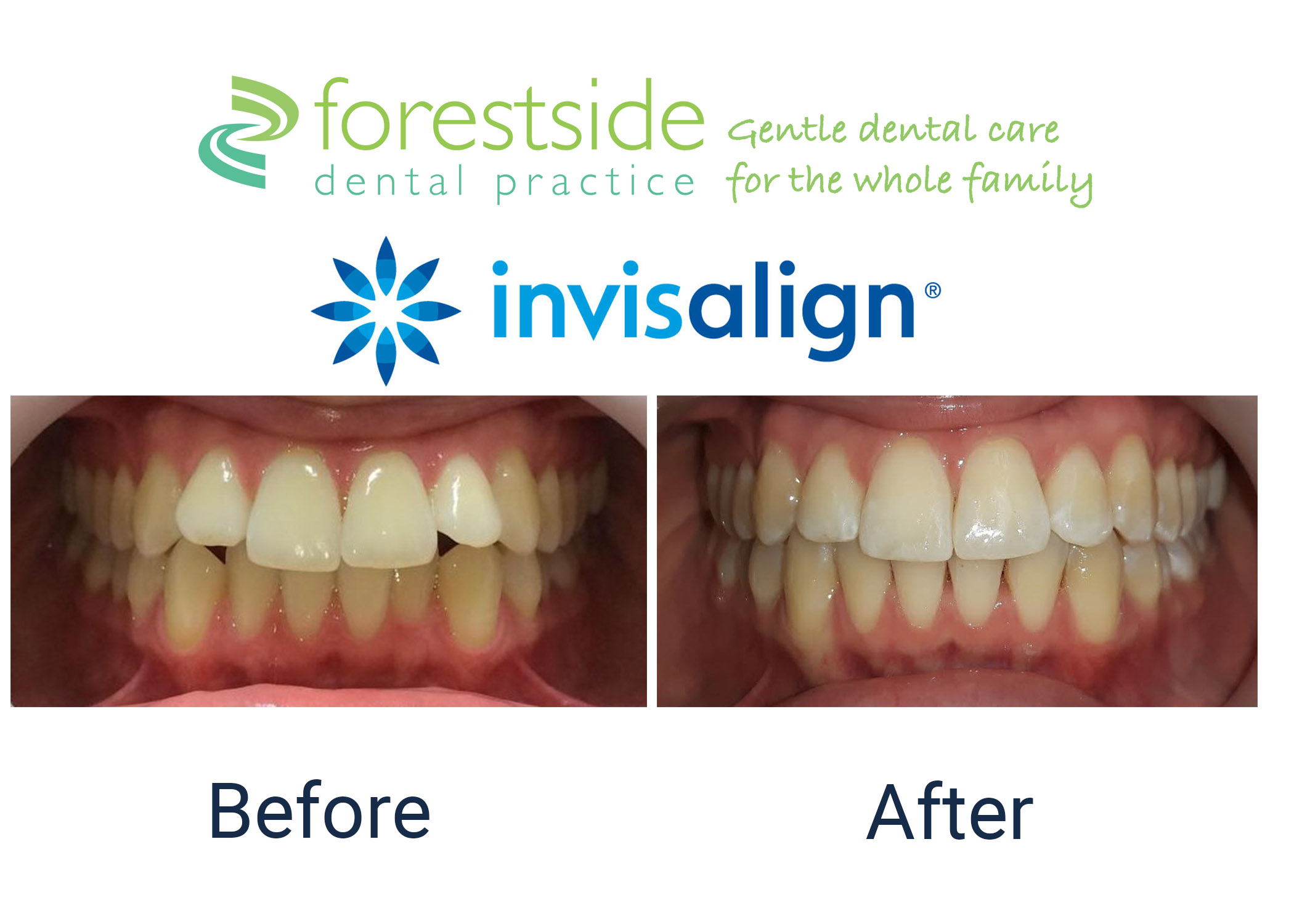 Invisalign b-a 1 invisalign doctor Brockenhurst