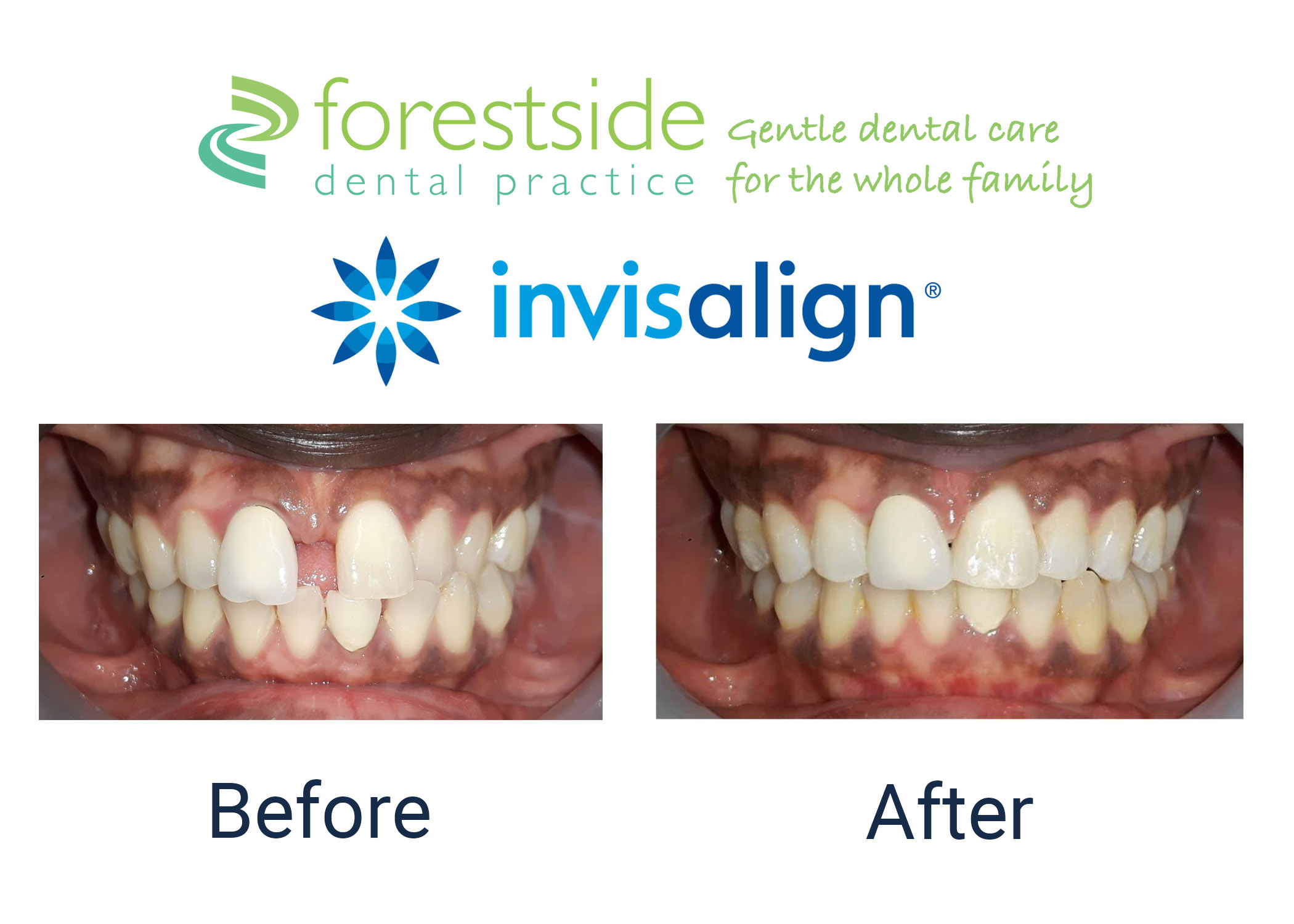 Invisalign b-a 2 invisalign cost Brockenhurst