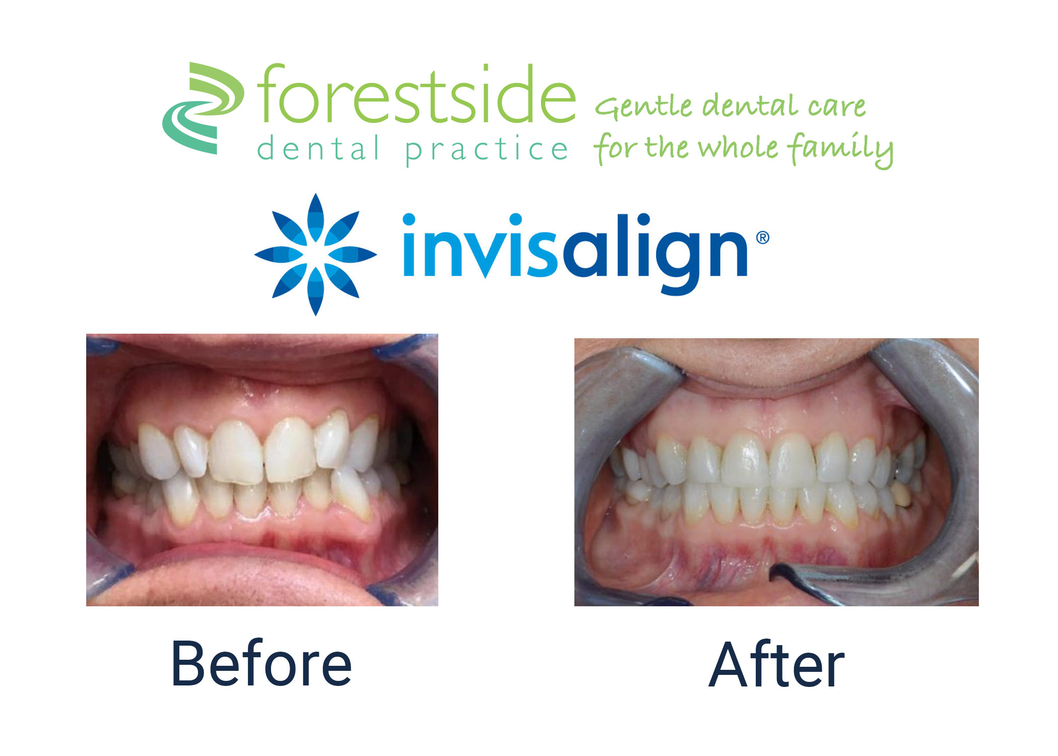 Invisalign b-a 3 Invisalign price Brockenhurst