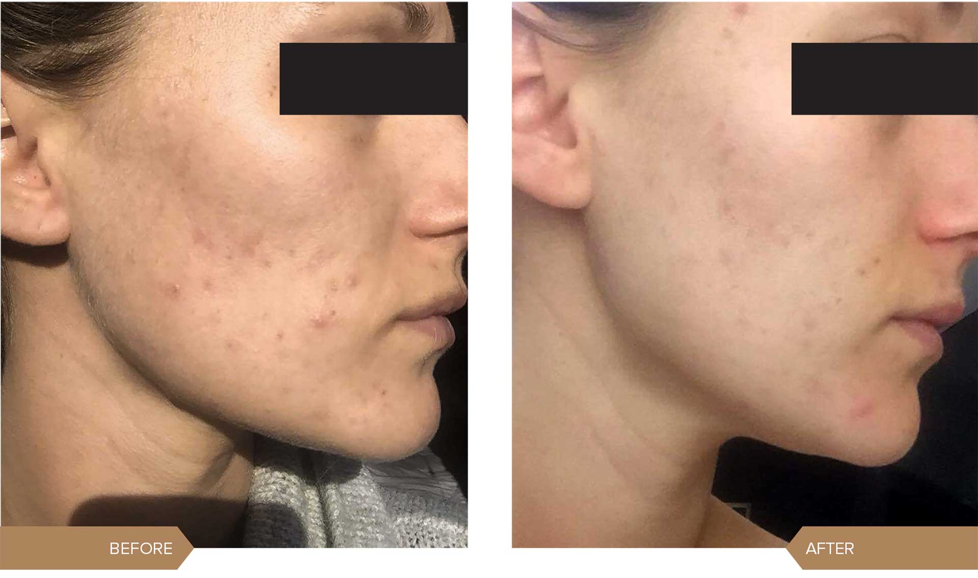 chemical-peel chemical-peel