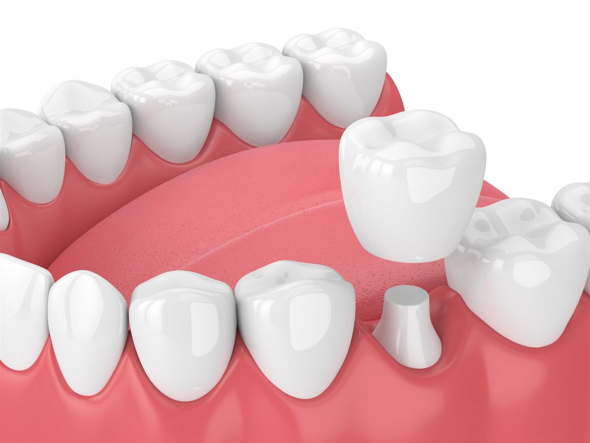 crown dental treatments hythe