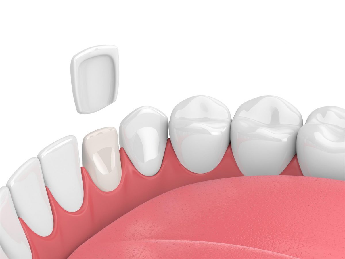 veneer veneer cosmetic dentistry hythe