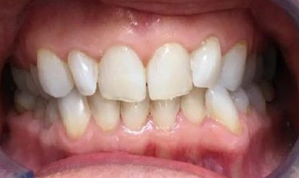 invisalign dentist hythe