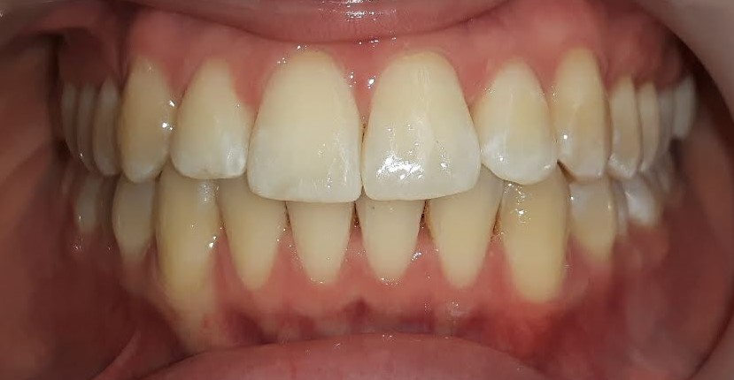 invisalign cost hythe