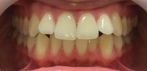 invisible braces hythe