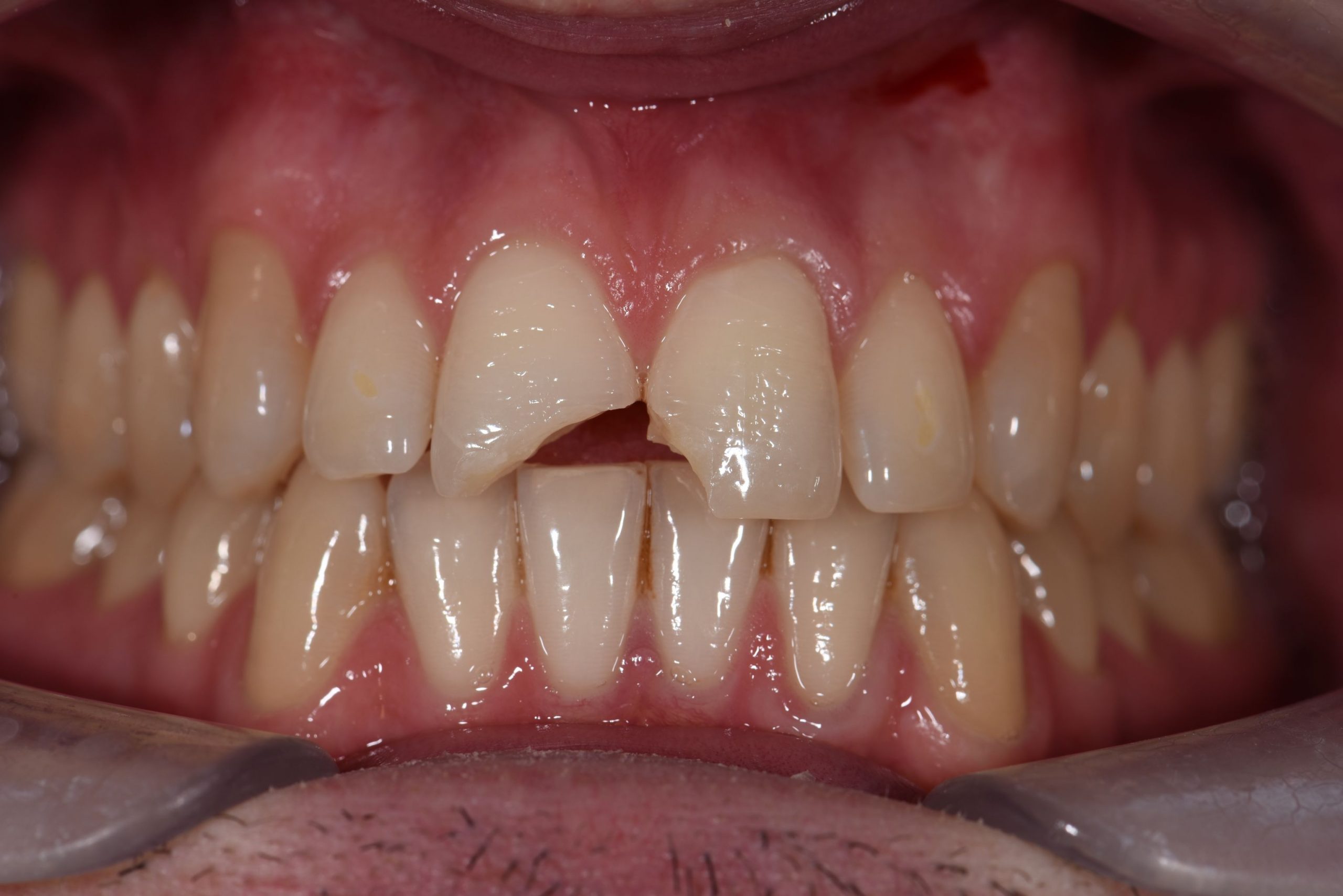 Broken front tooth before new forest