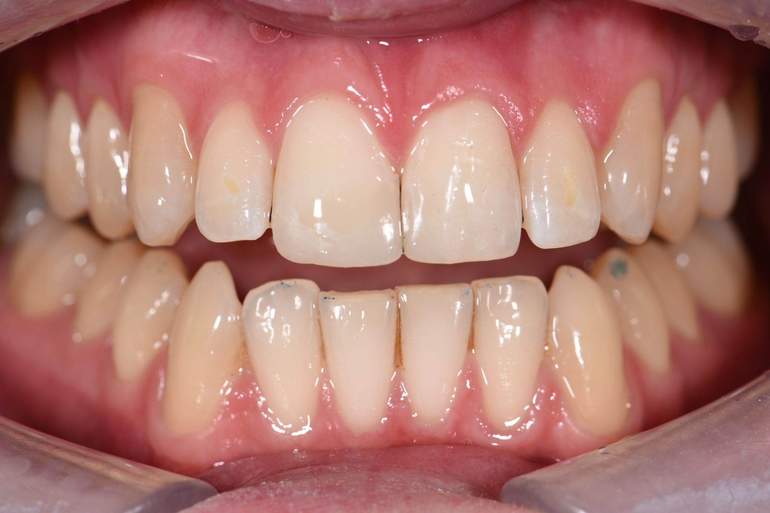 Broken front tooth fixed with composite bonging new forest