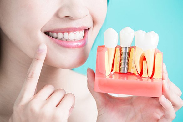 dental implants bassett